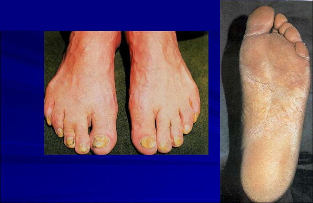Skvamózní-hyperkeratotická forma houby (rubromykóza nohy)