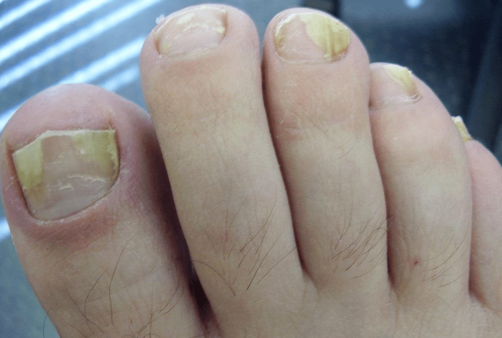 žluté nehty v důsledku houbové infekce