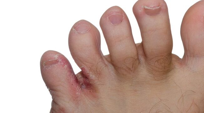 Známky plísně mezi prsty na nohou - praskliny a odlupování kůže
