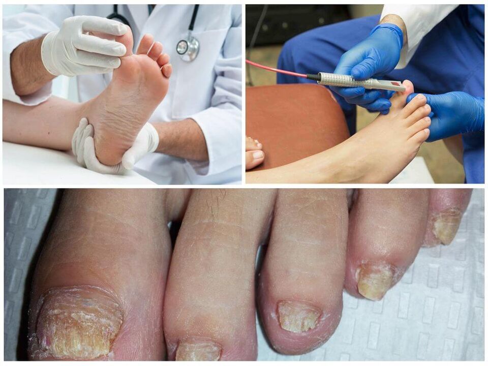 Lékař diagnostikuje a léčí nehty na nohou postižené houbovou infekcí. 