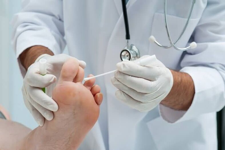 Pokud máte příznaky plísně nehtů na nohou, měli byste se poradit s dermatologem nebo mykologem. 
