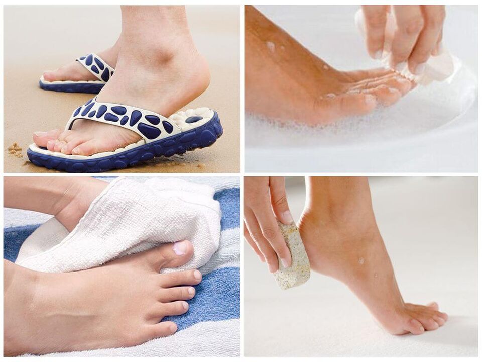 Prevence onychomykózy zahrnuje hygienu nohou, používání osobních věcí a včasnou pedikúru