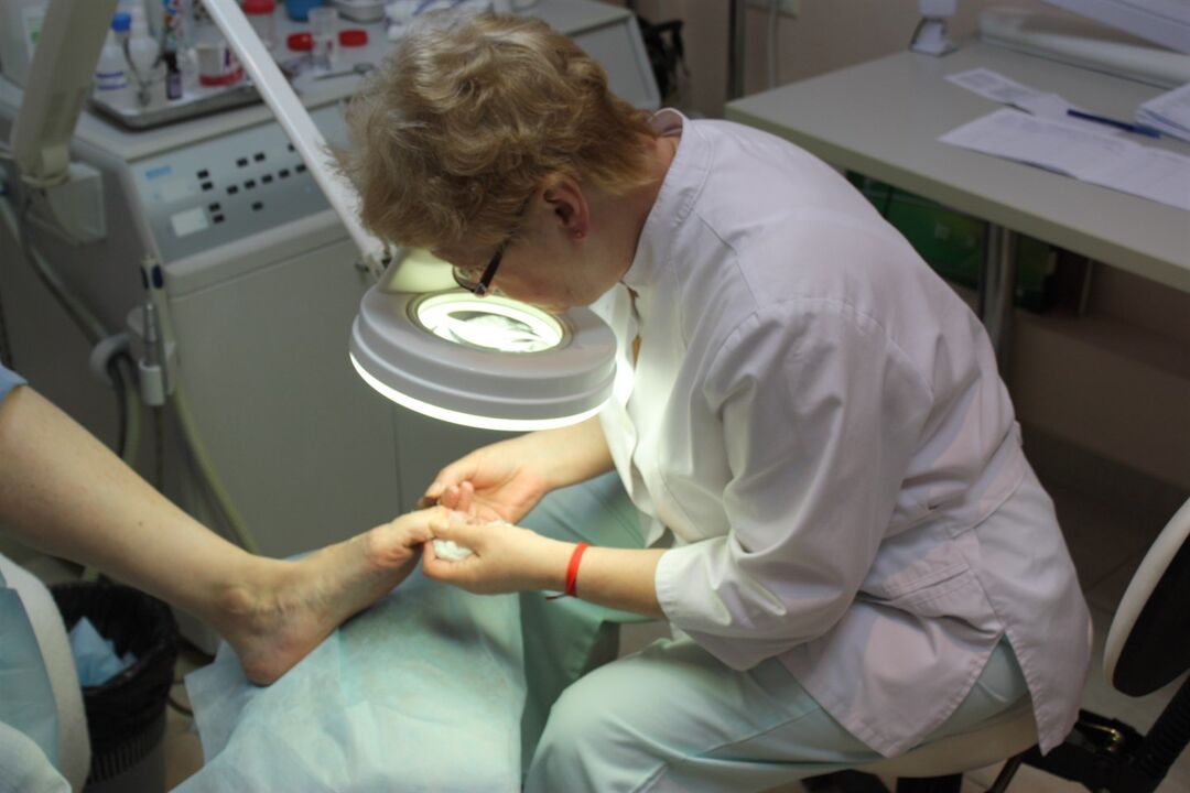 Působivý vývoj plísně nehtů na nohou vyžaduje pomoc chirurga